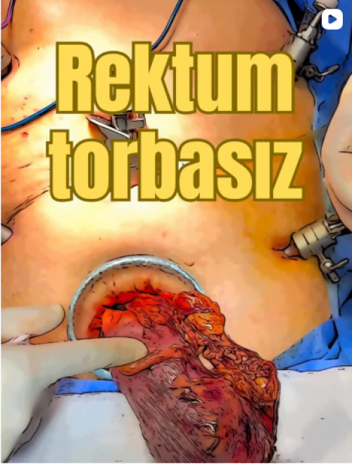 Rektum Kanseri Torbasız Ameliyat